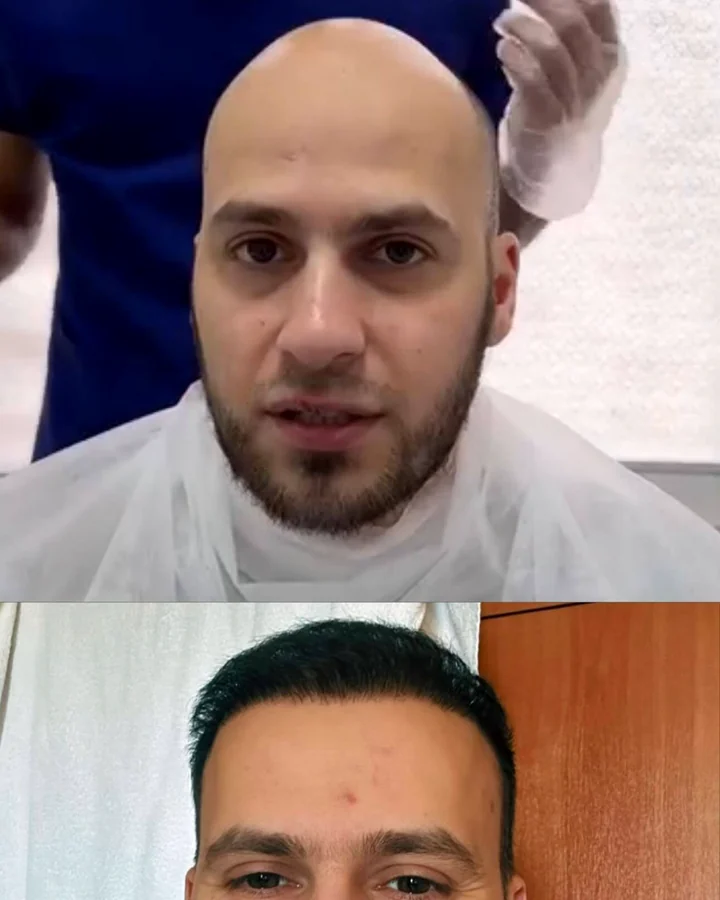 Реальный результат пациента USISHA