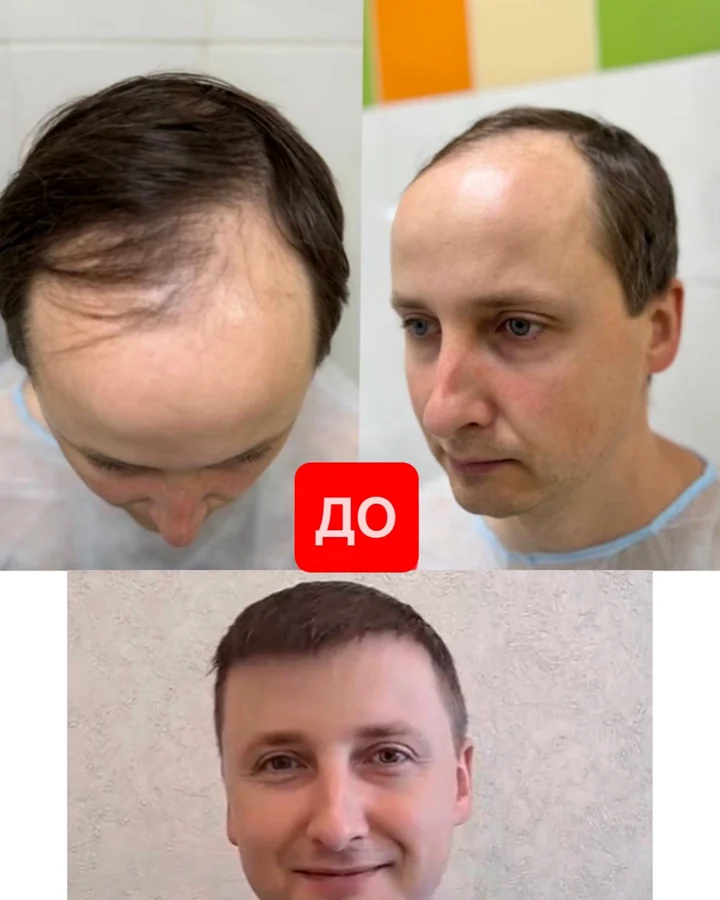 Реальный результат пациента USISHA
